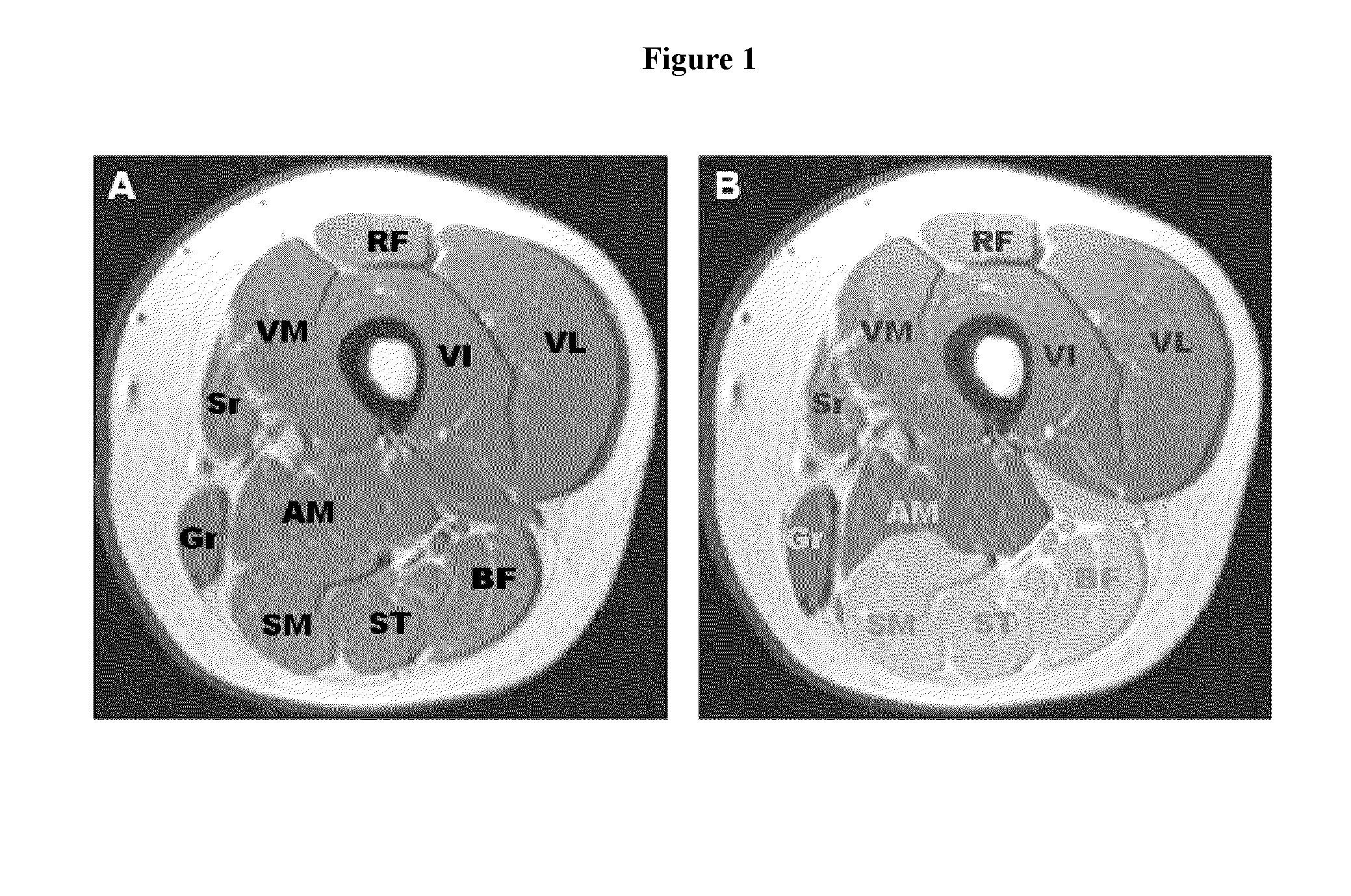 Method for diagnosing cmt1a and cmt2a by MRI