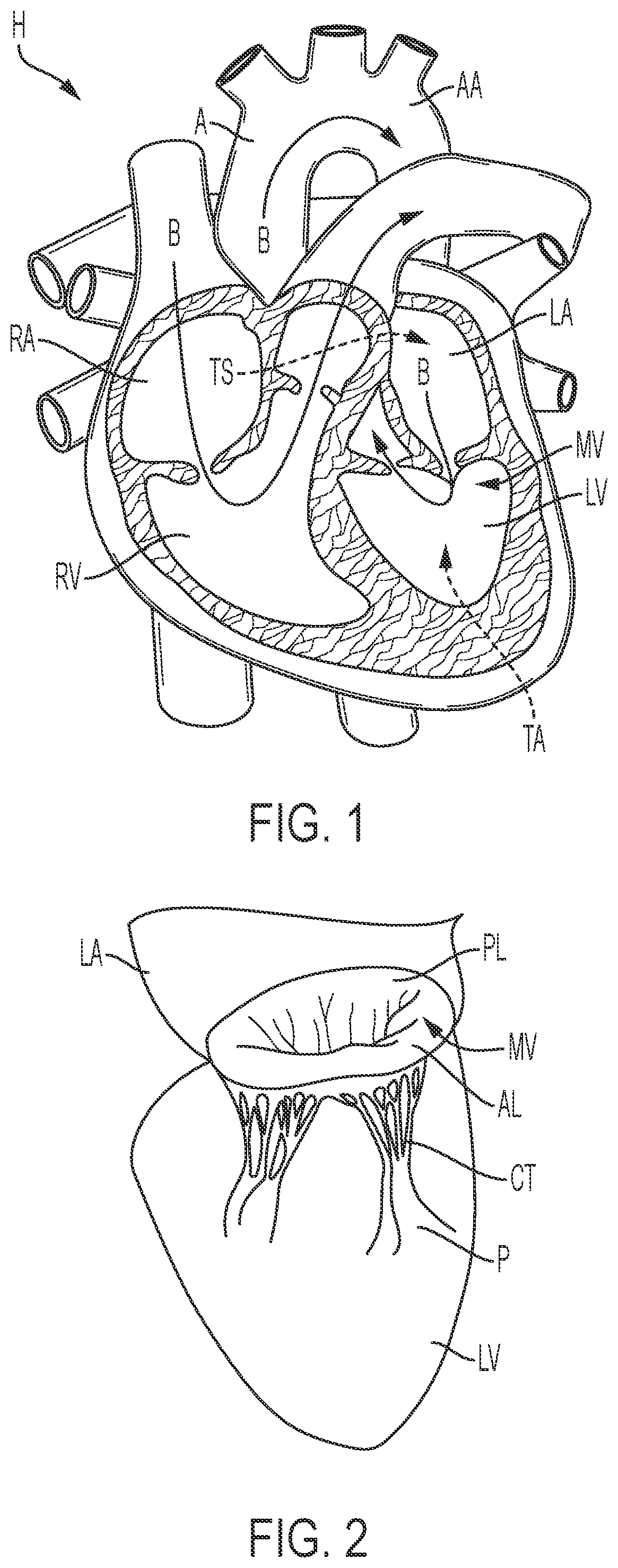 Transcatheter Mitral Valve Fixation Concepts