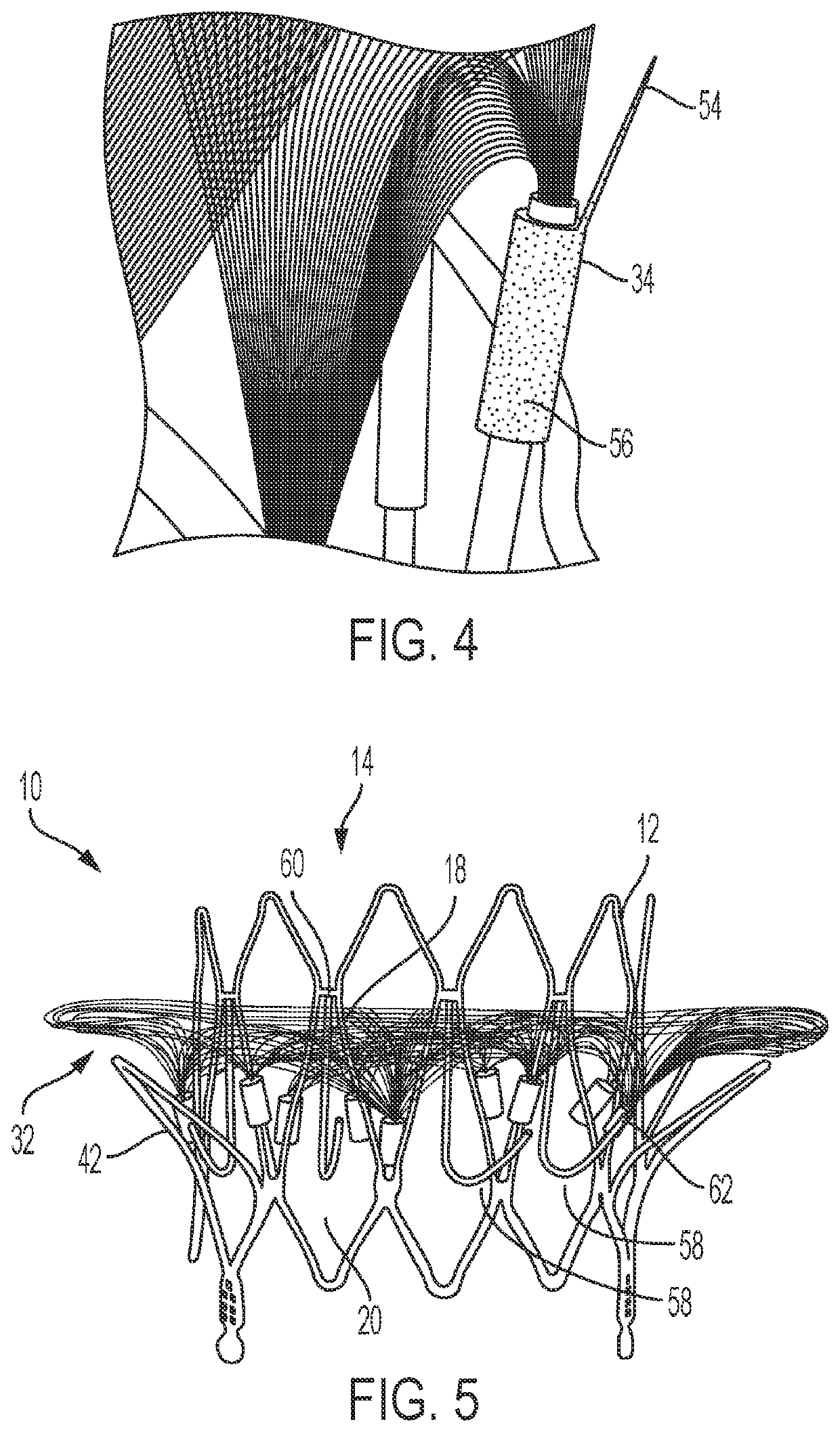 Transcatheter Mitral Valve Fixation Concepts