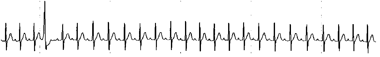 Heart rate turbulence tendency extraction method based on cloud model and scatter diagram