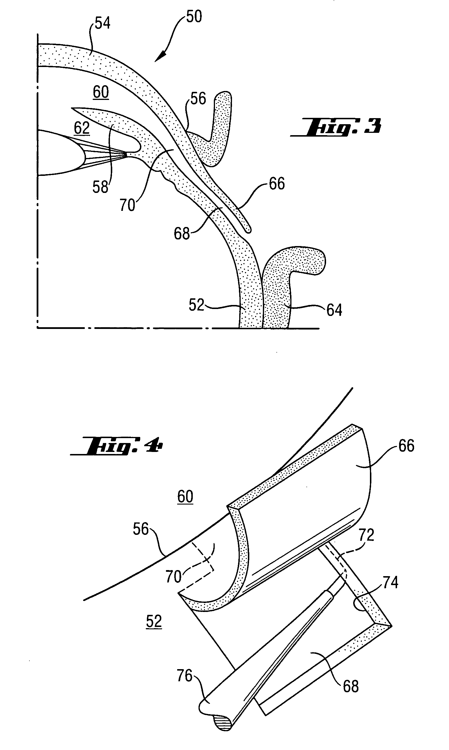 Article and method for ocular aqueous drainage