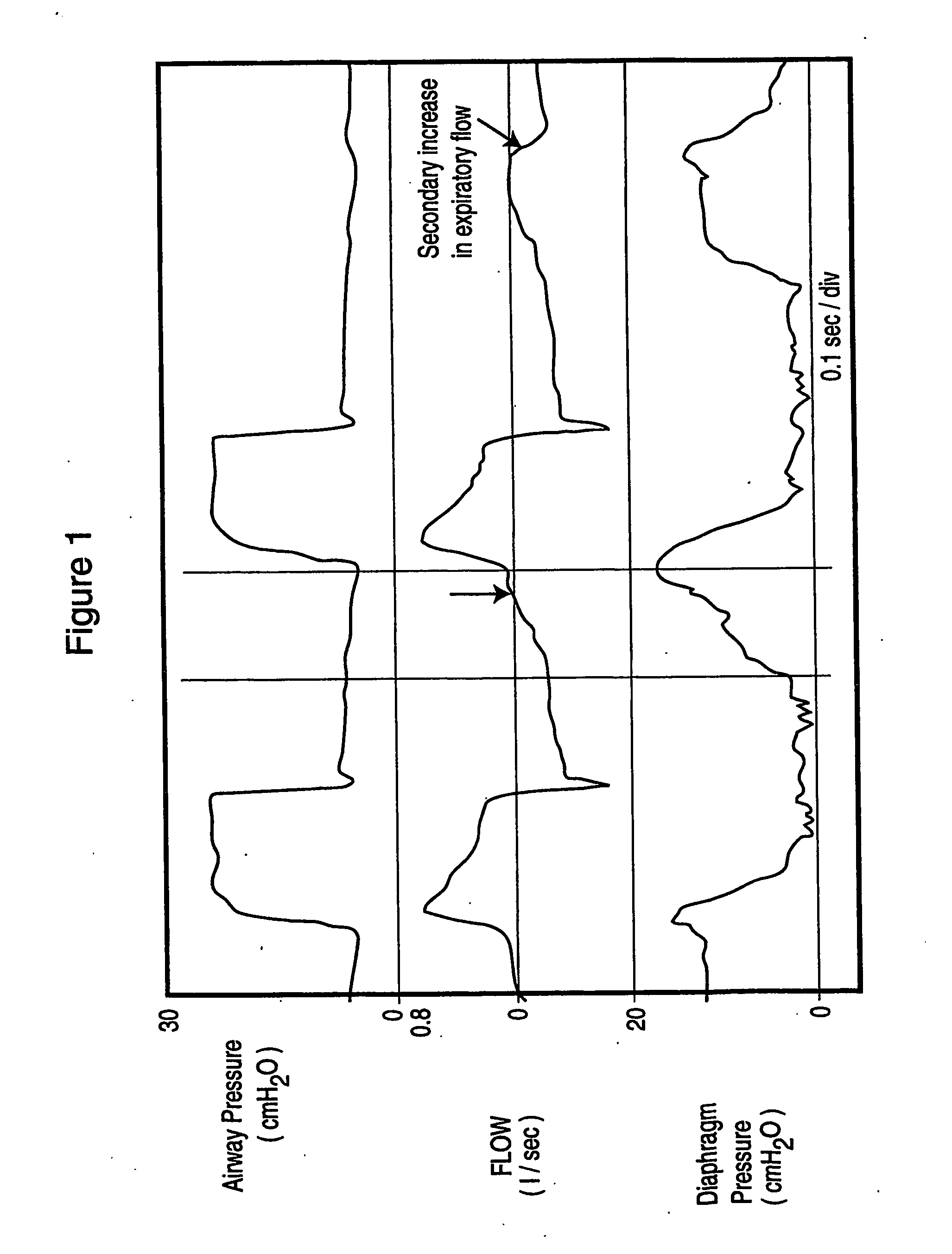 Method and device for monitoring and improving patient-ventilator interaction