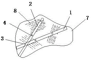 Bionic fixing device for treating calcaneal fractures