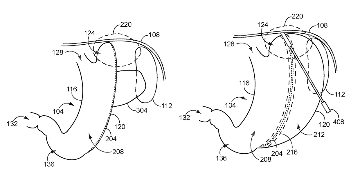 Safe sleeve gastrectomy