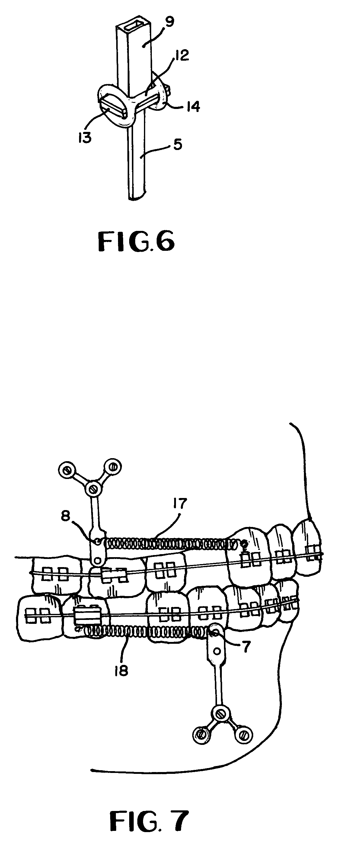 Orthodontic anchor