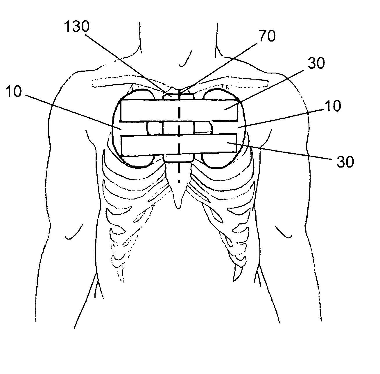 Sternotomy splinting assembly, kit and method for use