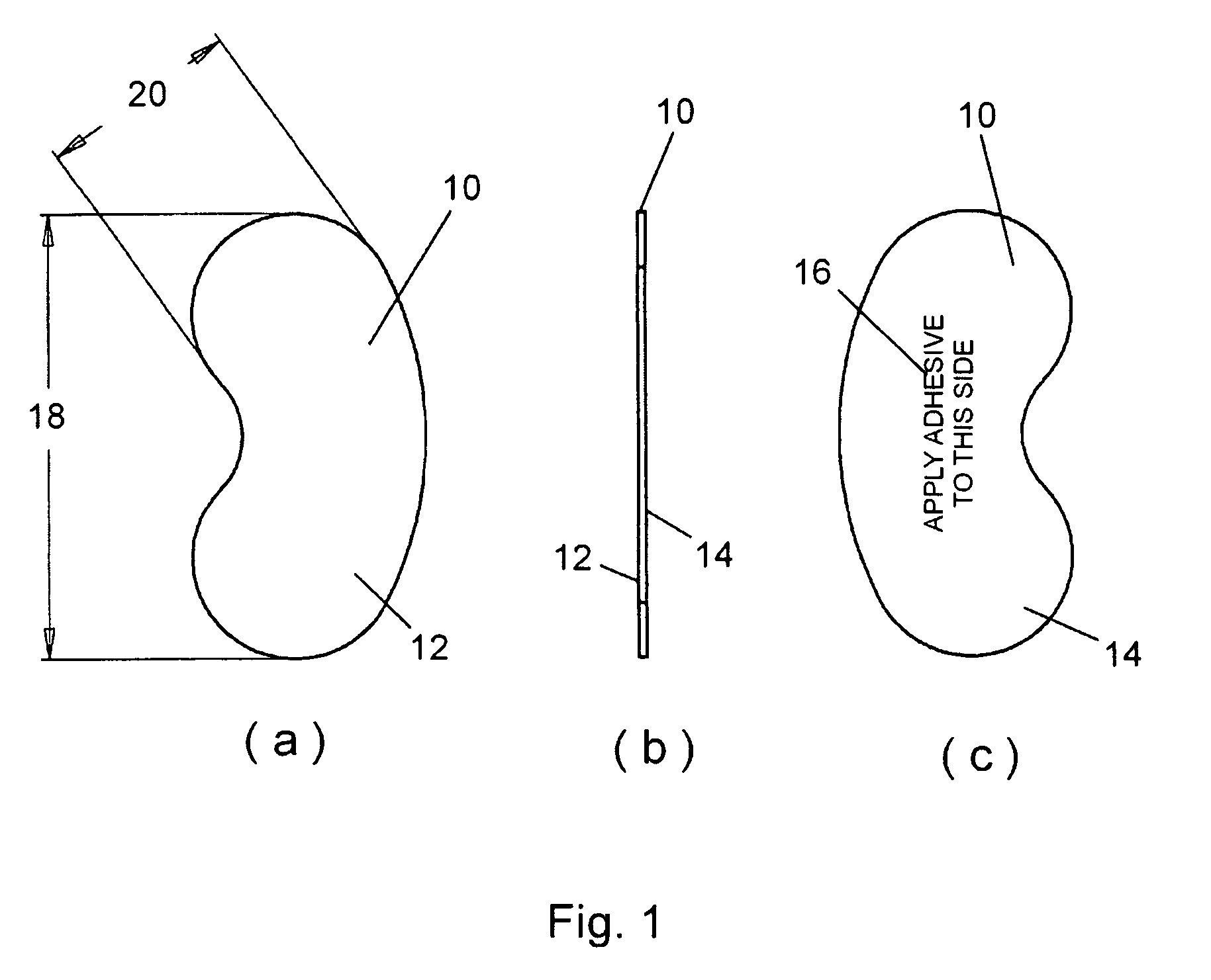 Sternotomy splinting assembly, kit and method for use