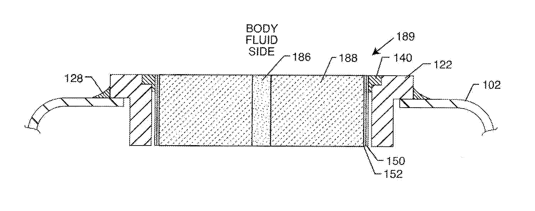 EMI Filtered Co-Connected Hermetic Feedthrough, Feedthrough Capacitor and Leadwire Assembly for an Active Implantable Medical Device