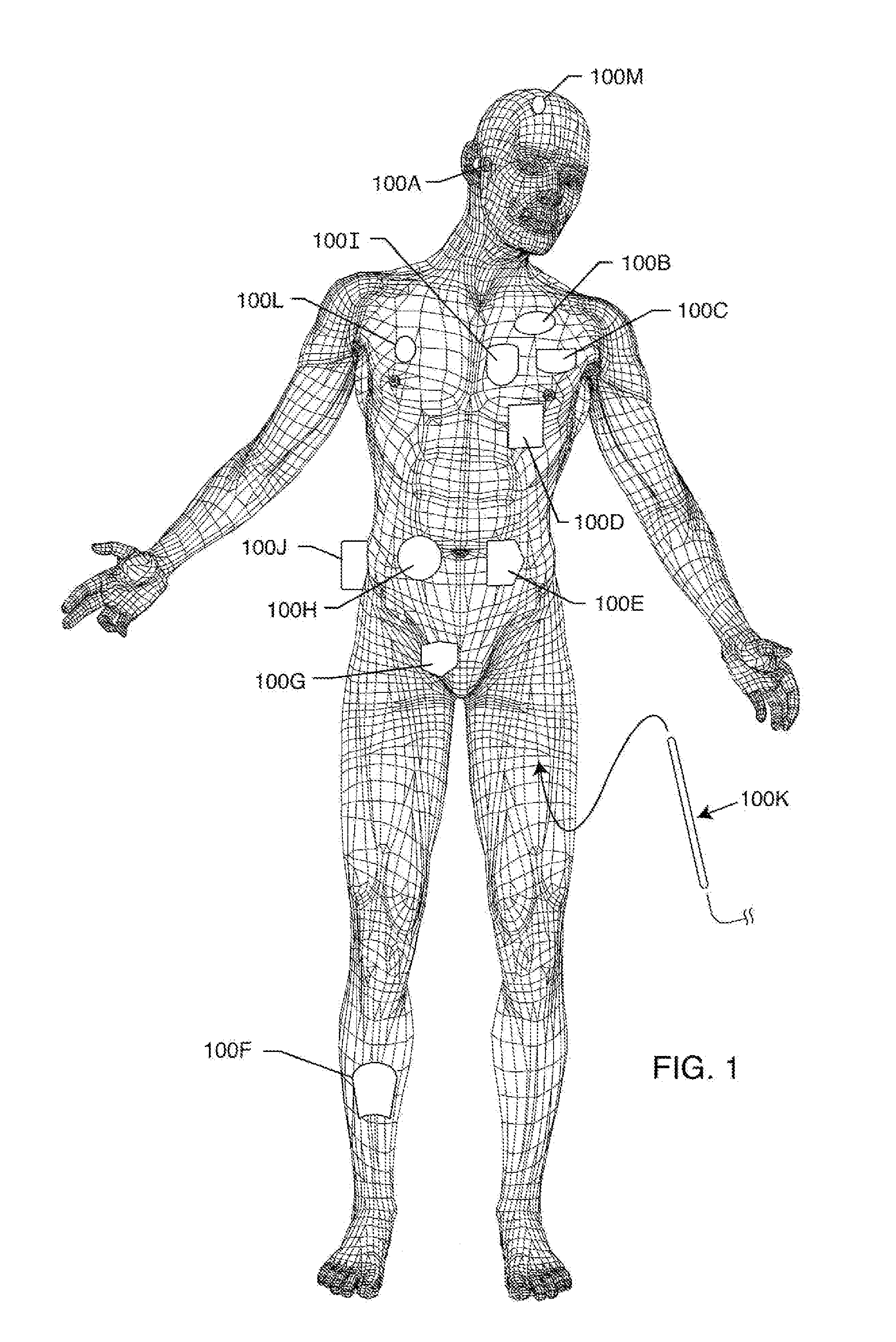 EMI Filtered Co-Connected Hermetic Feedthrough, Feedthrough Capacitor and Leadwire Assembly for an Active Implantable Medical Device