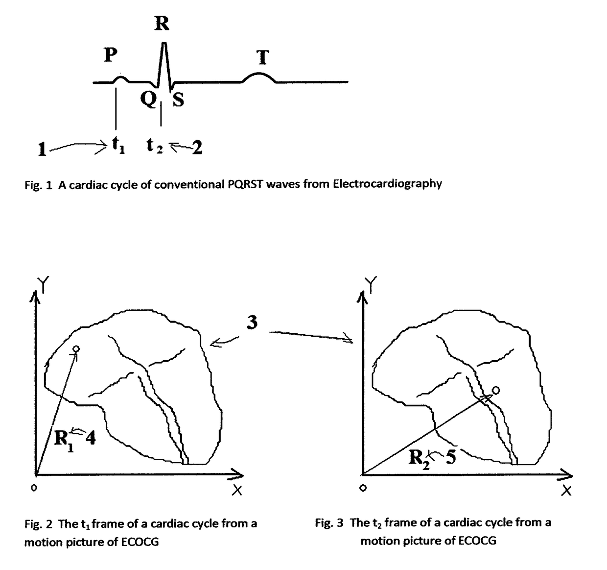 Calibration of two synchronized motion pictures from magnetocardiography and echocardiography