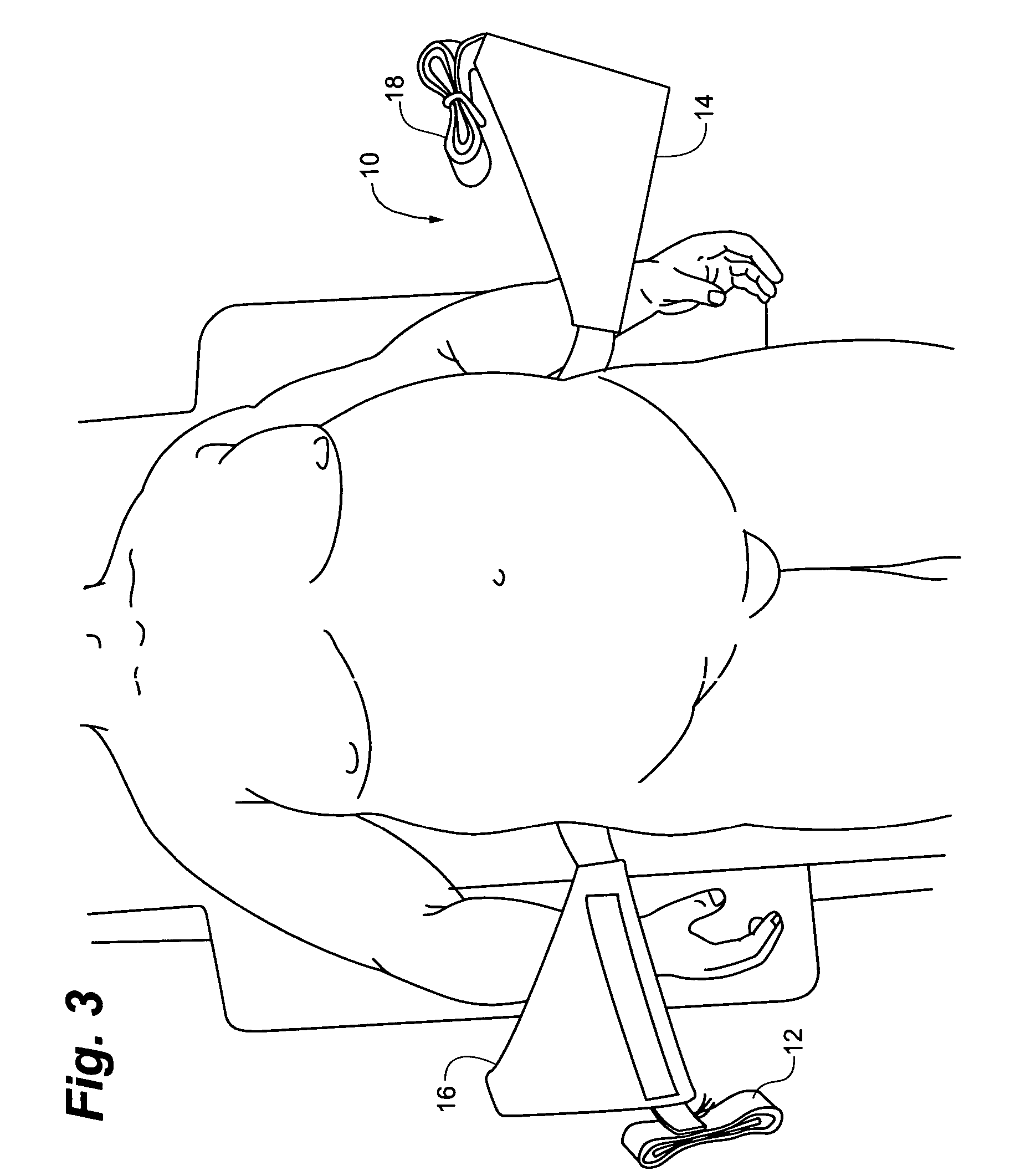 Abdominal tissue support for femoral puncture procedures