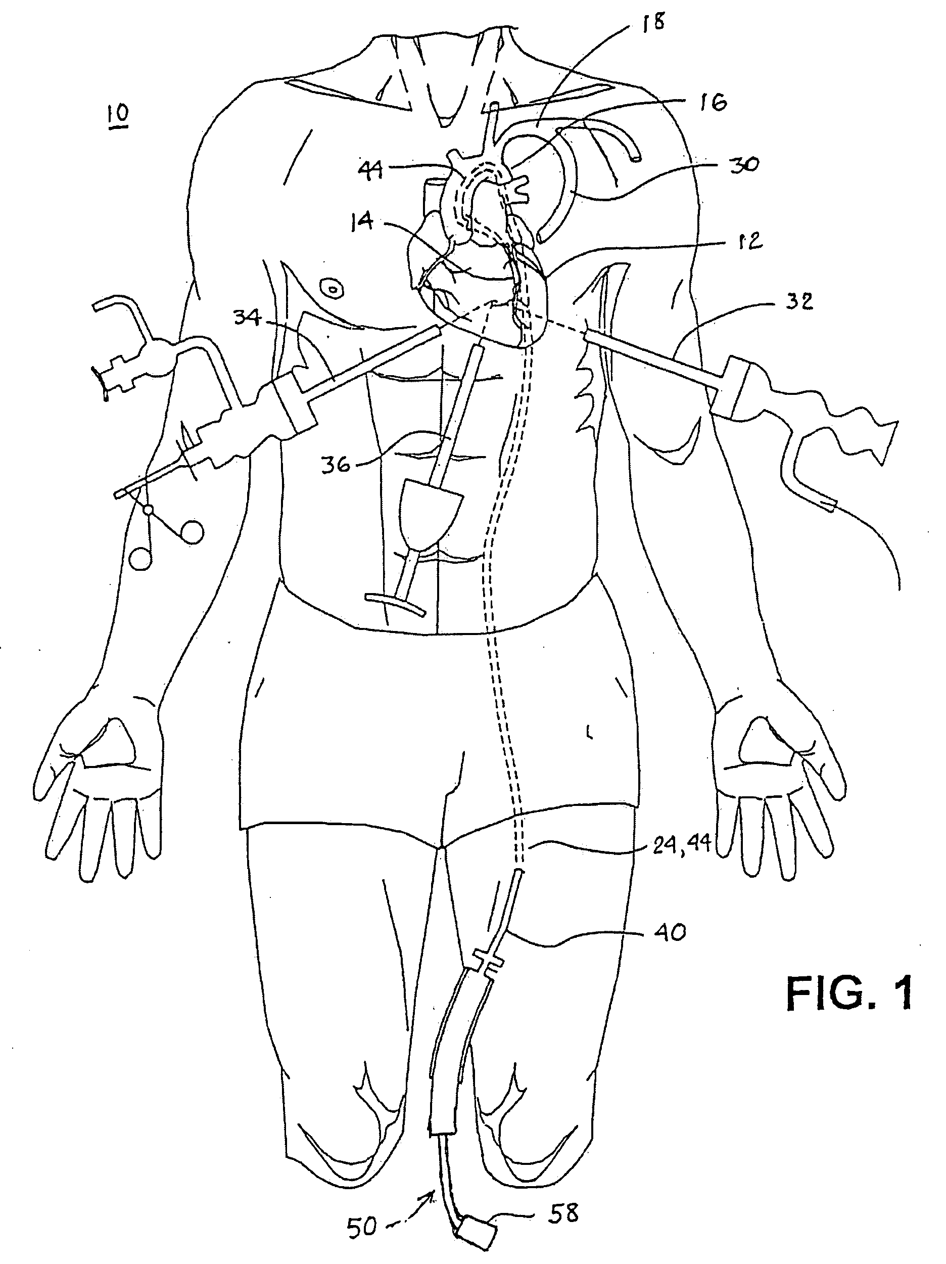 Methods and Apparatus for Locating Body Vessels and Occlusions in Body Vessels