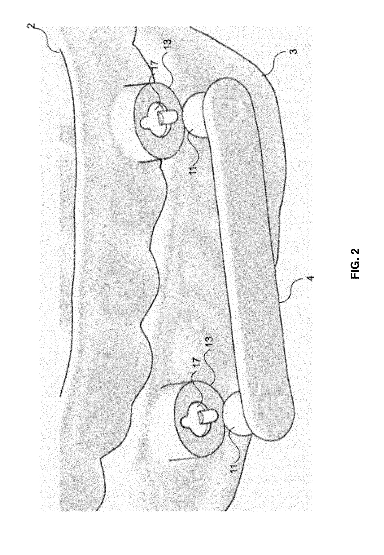 Intraoral Orthosis for Mandibular Advancement for Snoring and Obstructive Sleep Apnea