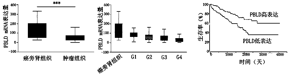 Application of PBLD gene in preparation of medicine for diagnosing renal clear cell carcinoma and predicting prognosis of same