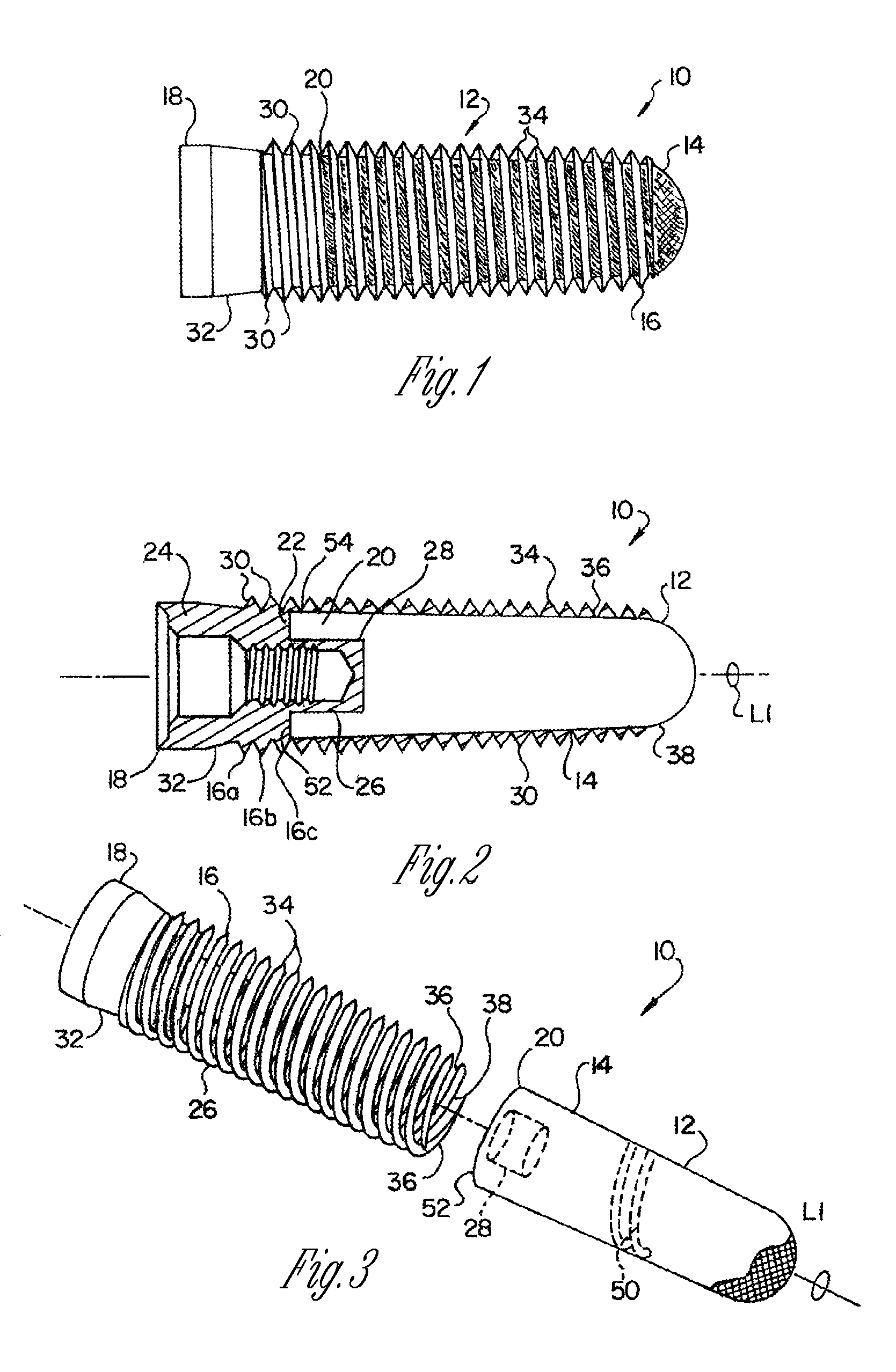 Porous implant with non-porous threads