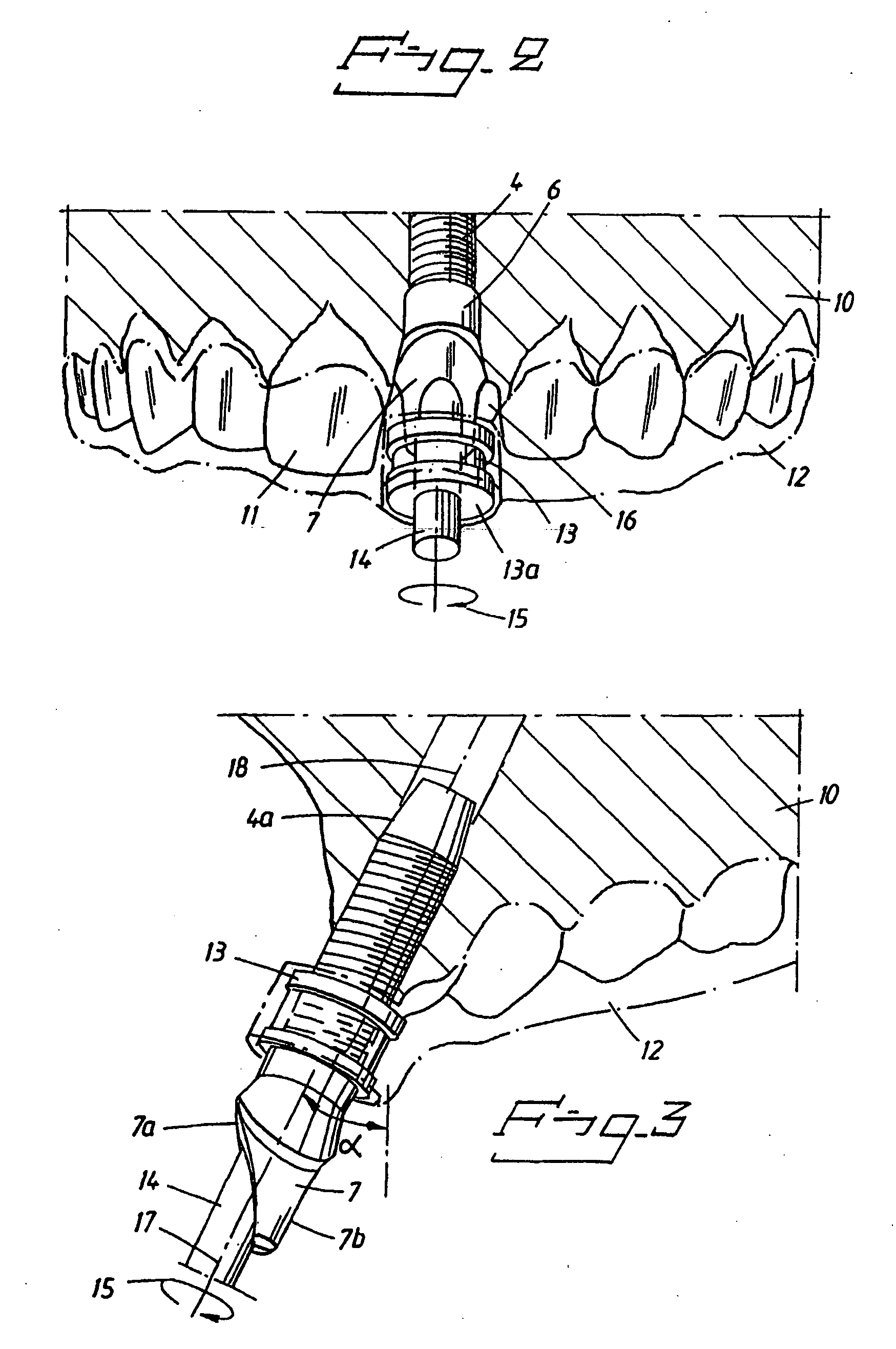 Tooth implant arrangement