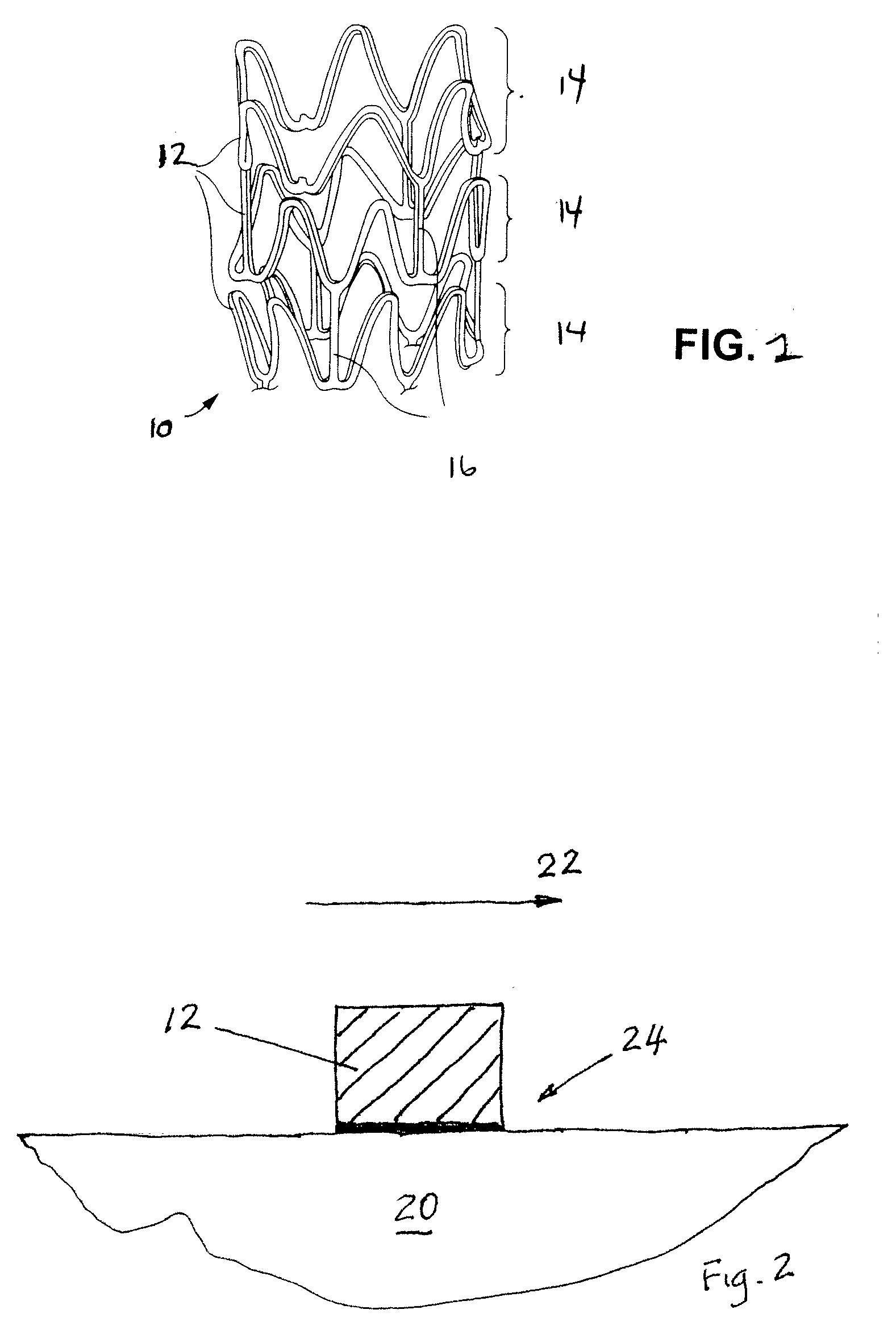 Stent and method for making a stent