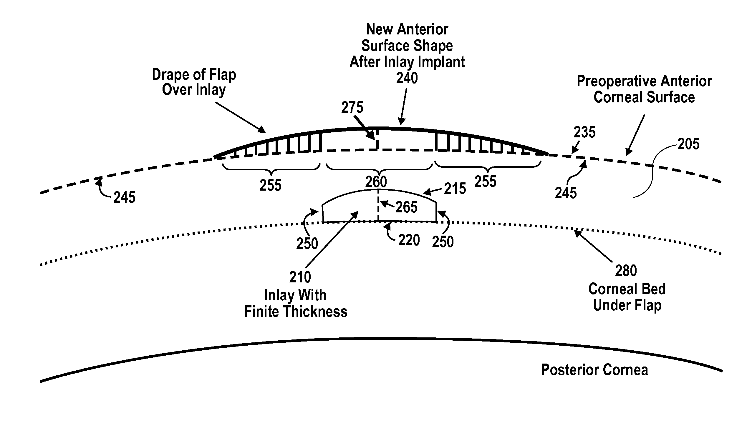 Corneal inlay design and methods of correcting vision