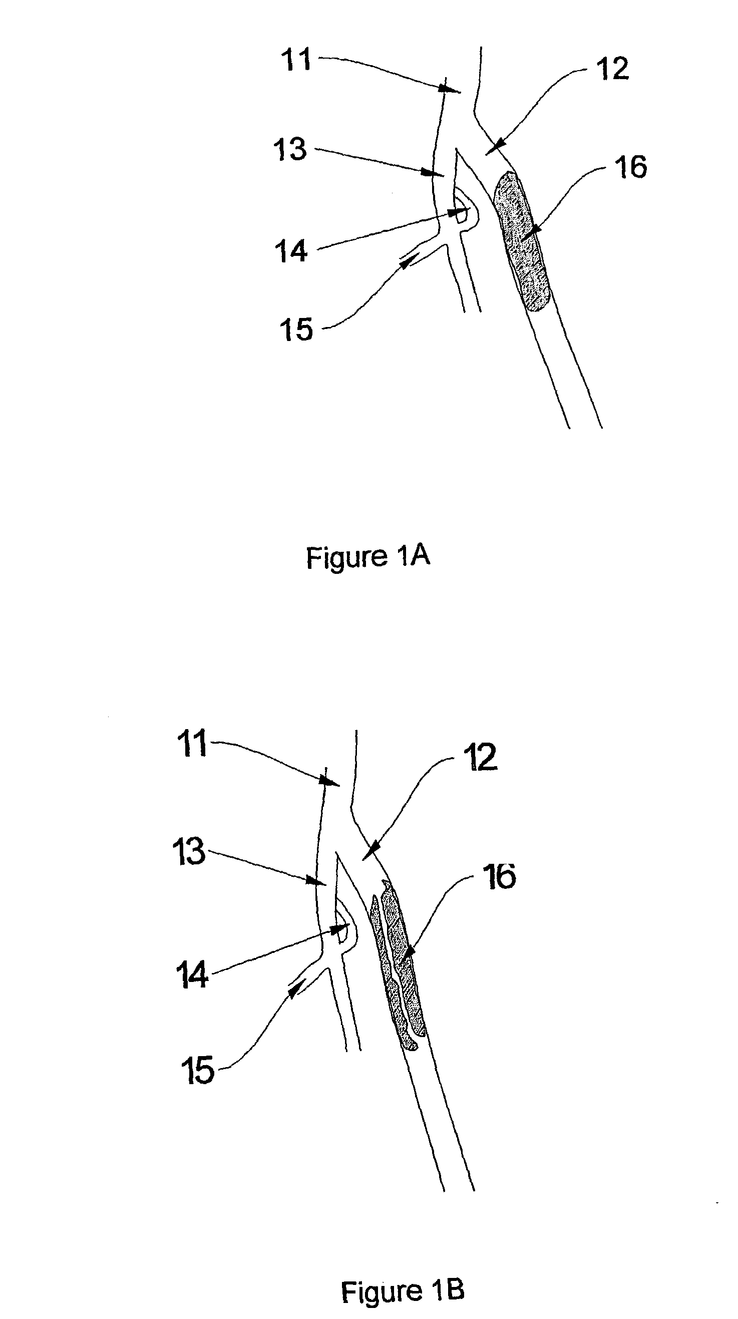 Methods for enhancing fluid flow through an obstructed vascular site, and systems and kits for use in practicing the same