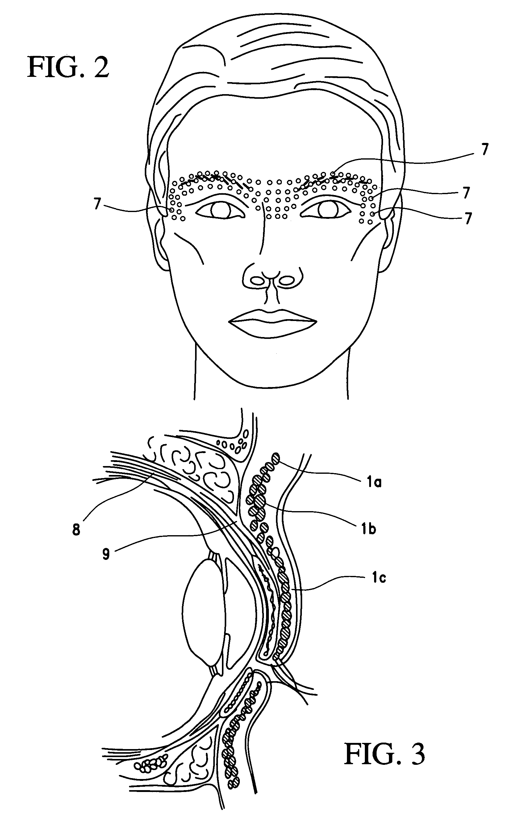 Cosmetic use of botulinum toxin for the treatment of eyebrow and forehead ptosis, and unwanted eyebrow expression