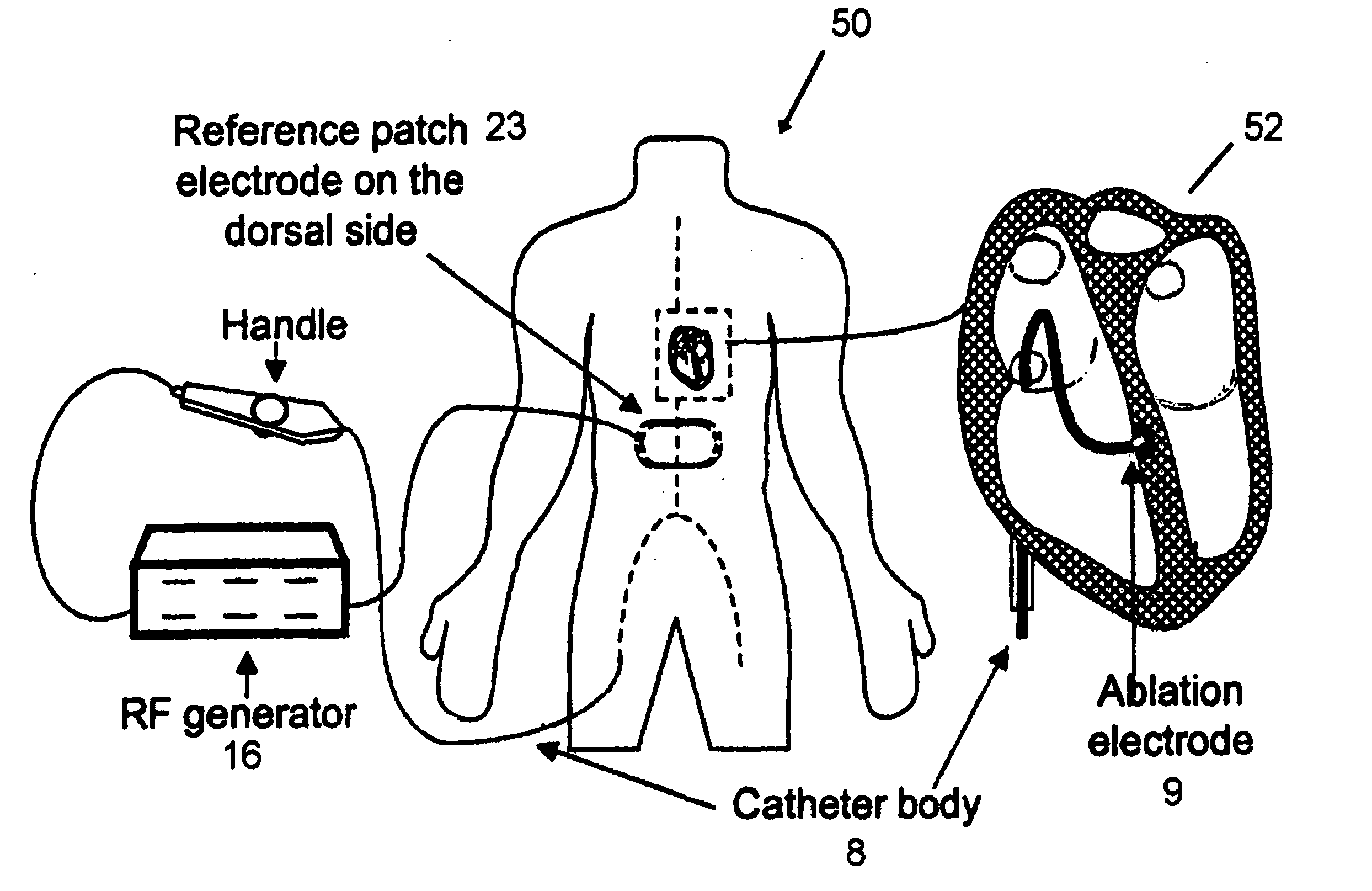 Method and system for monitoring atrial fibrillation ablations with an ablation interface device