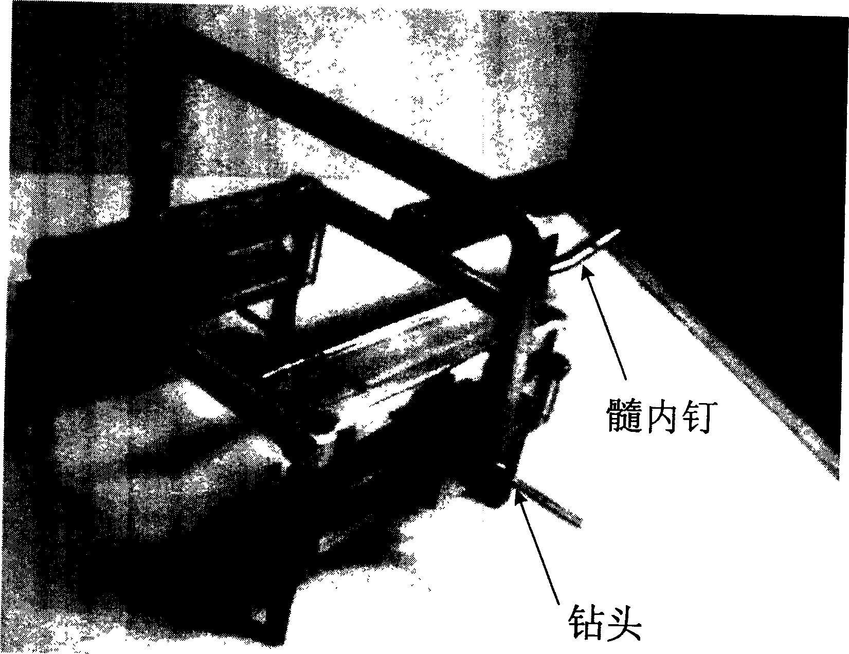 Computer aided system for locking far terminal of intramedullary nail