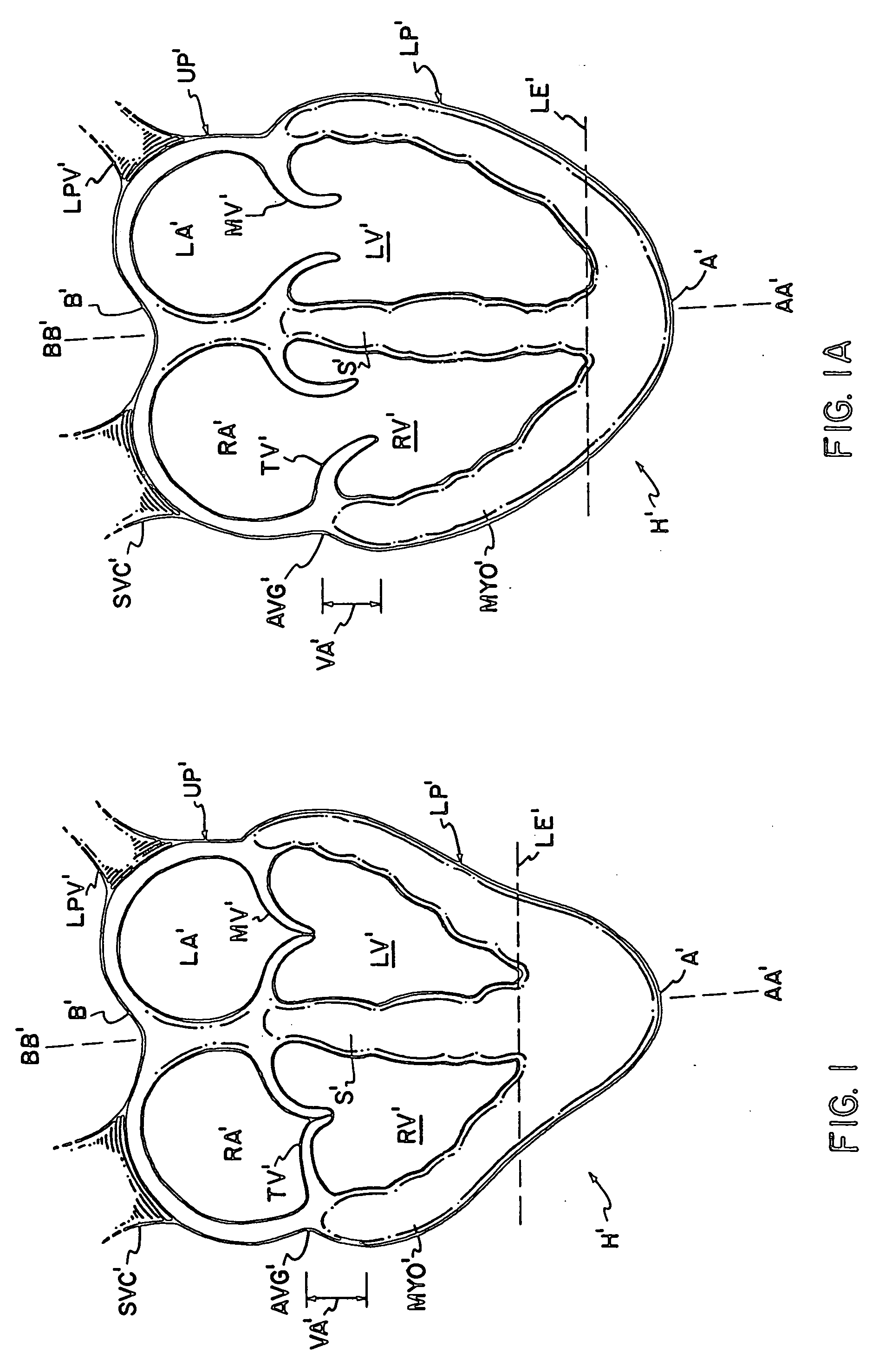 Compliant cardiac support device