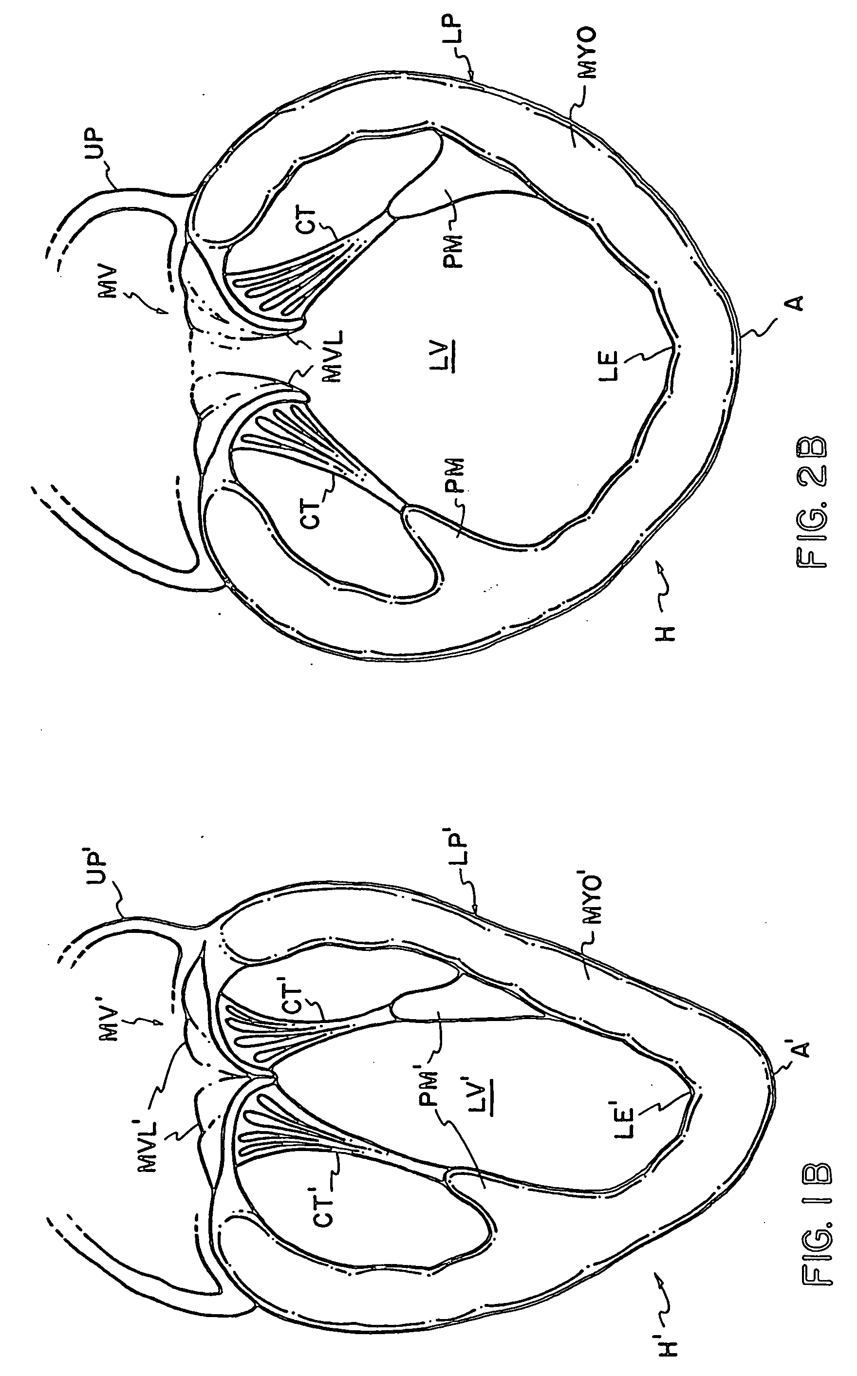 Compliant cardiac support device