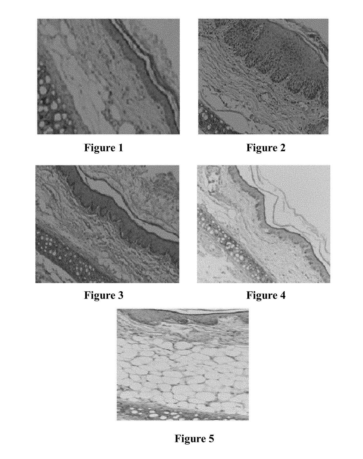 Uses of chlorogenic acid in the preparation of medicaments for treatment of psoriasis