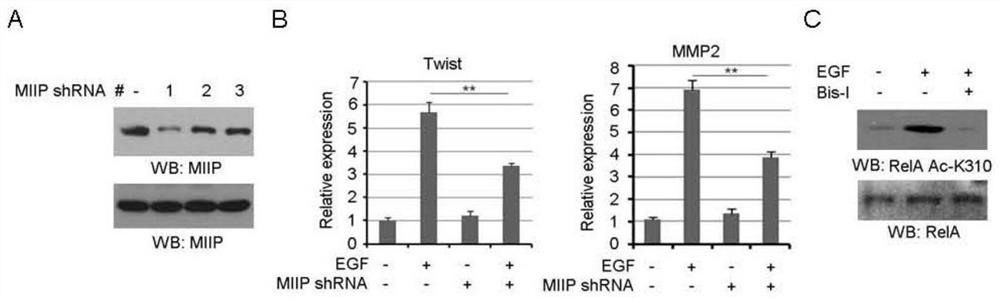 Application of miip pS303 blocker in the preparation of antitumor drugs