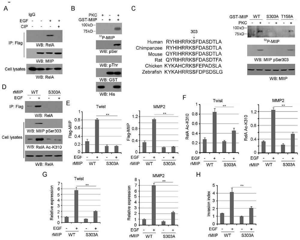 Application of miip pS303 blocker in the preparation of antitumor drugs