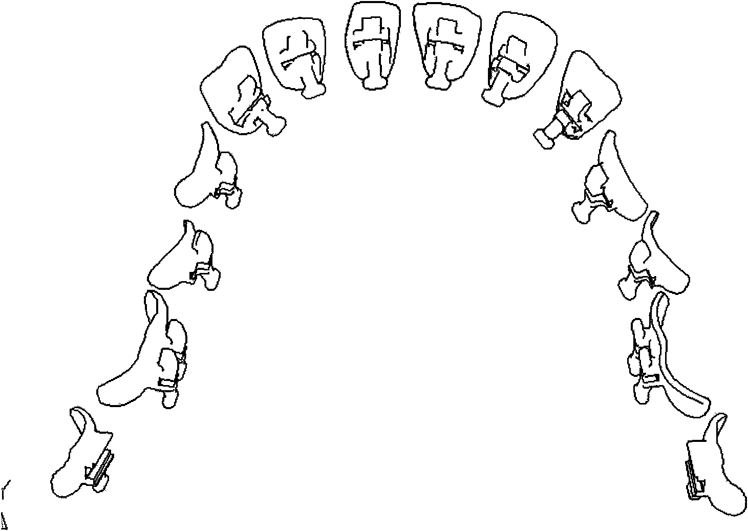 Manufacture method of individual orthodontic appliance for tongue