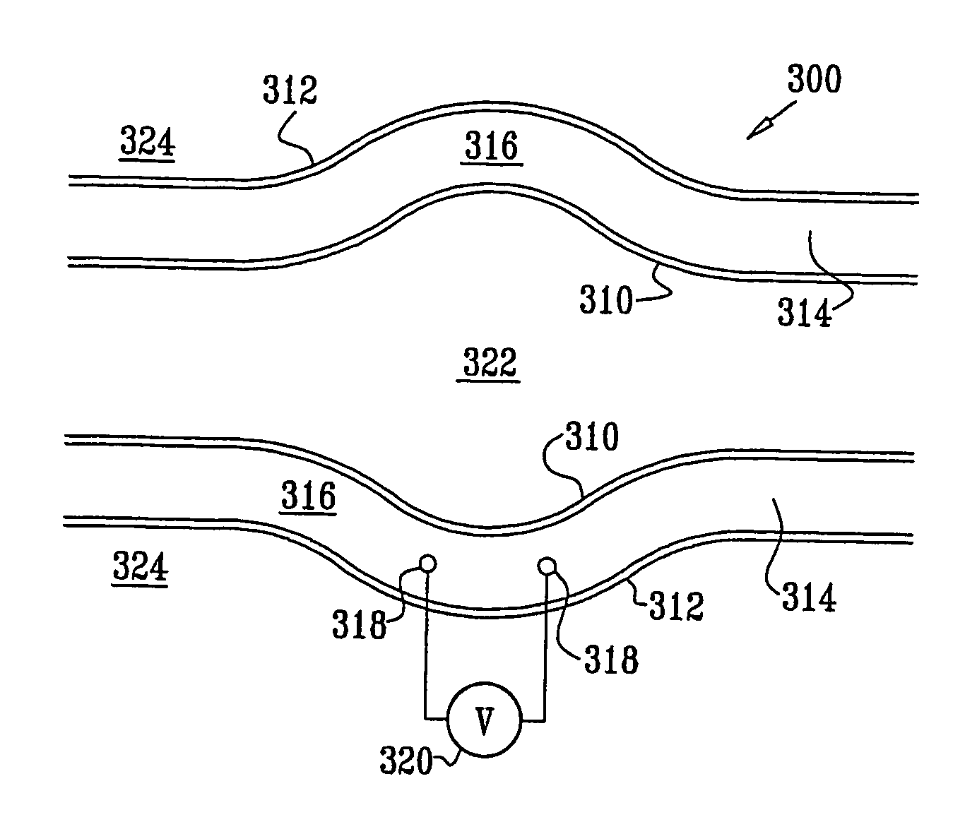 Fully-implantable cardiac recovery system