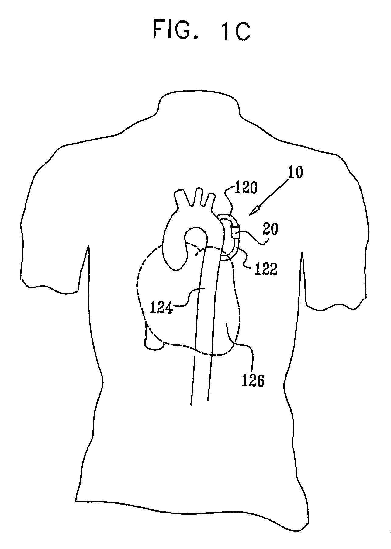 Fully-implantable cardiac recovery system