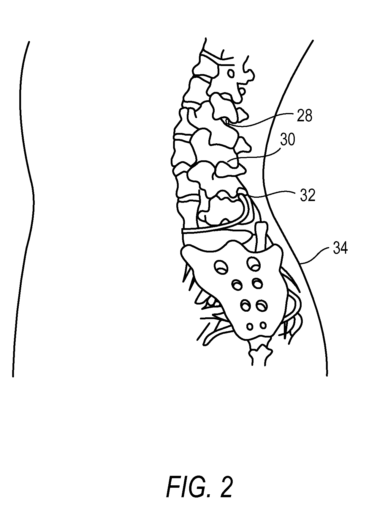 Methods for treating conditions such as dystonia and post-stroke spasticity with clonidine