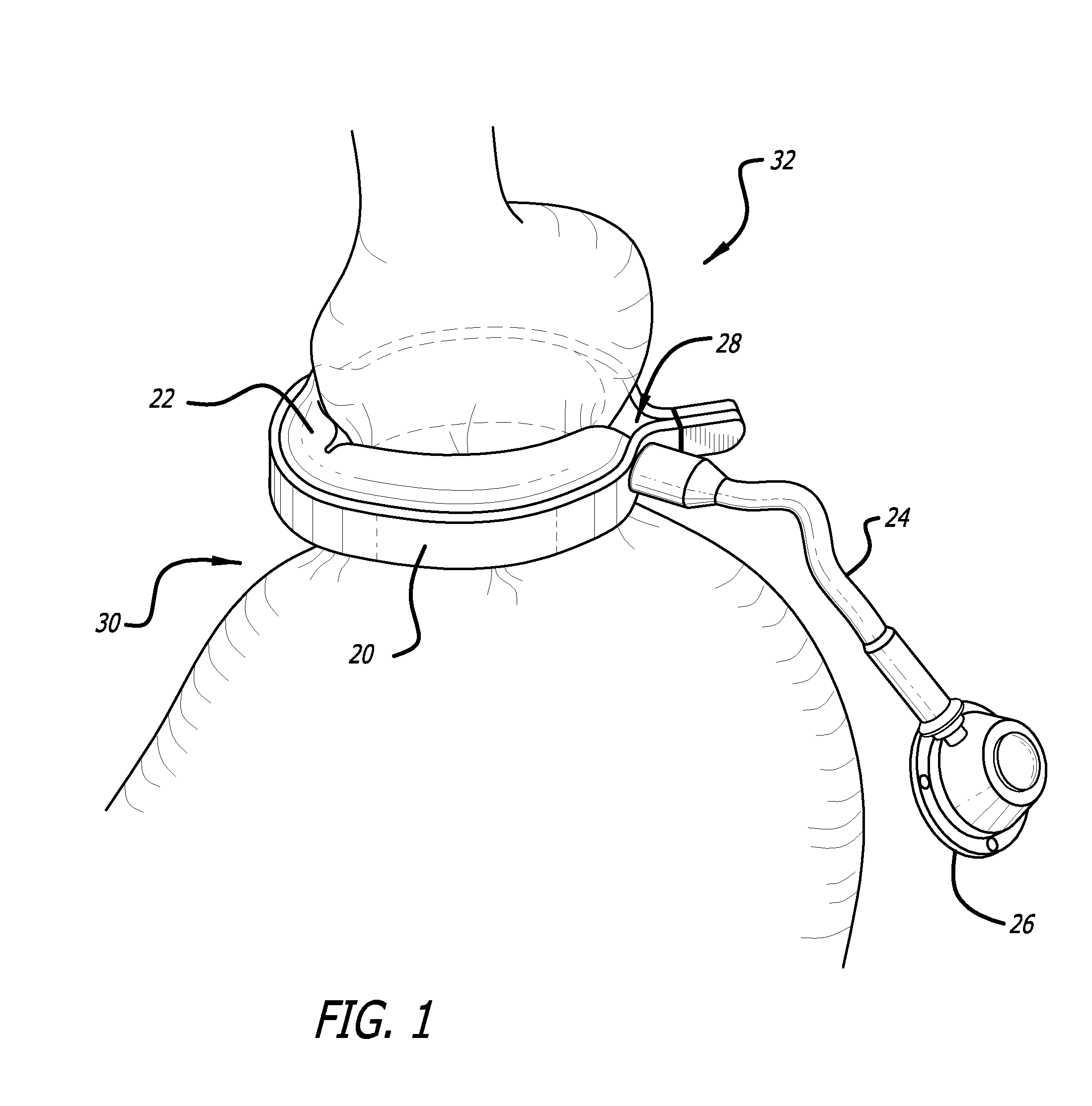 Method for increasing distensibility in a gastric band