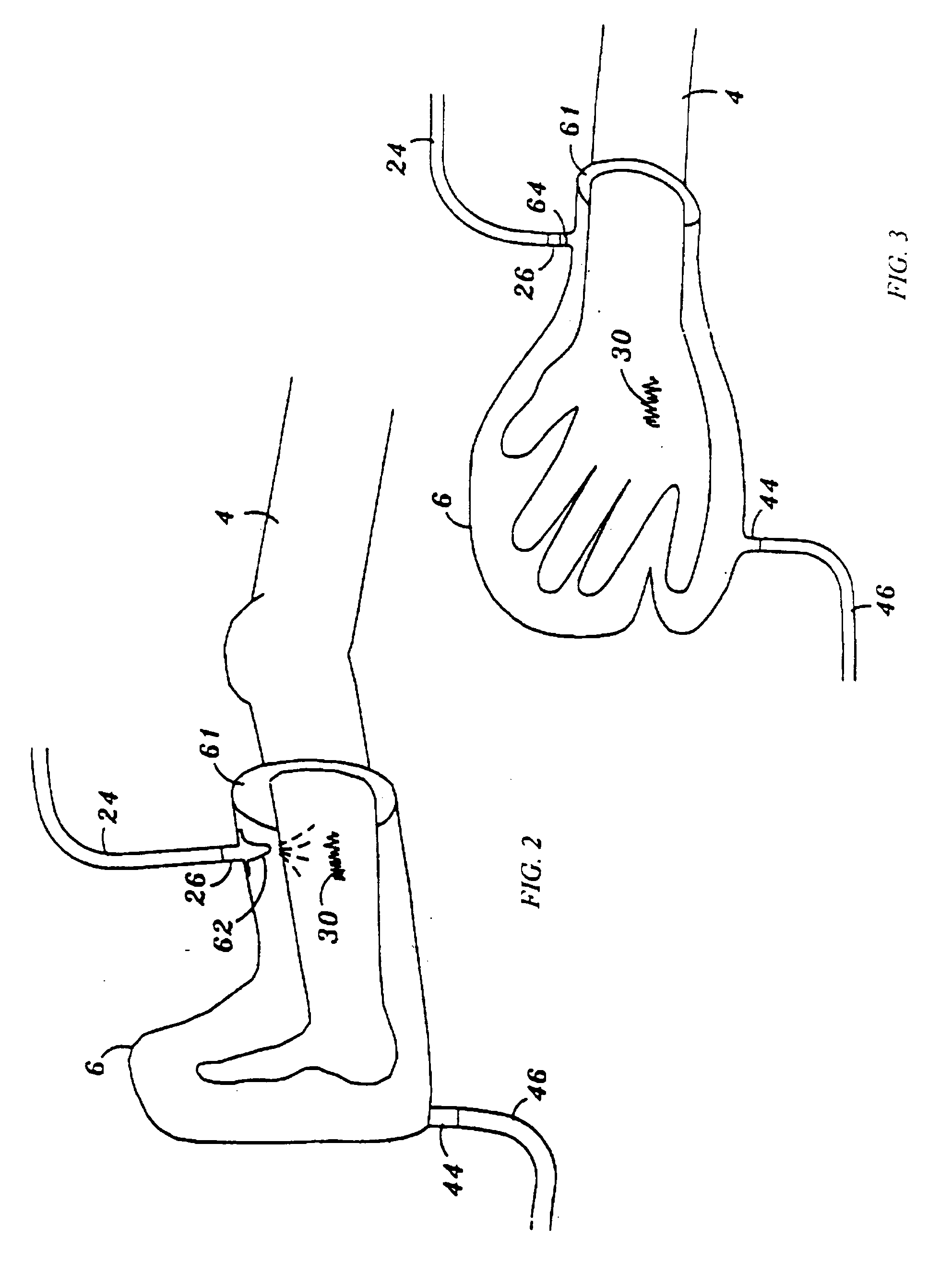 Device and method for treatment of wounds with nitric oxide