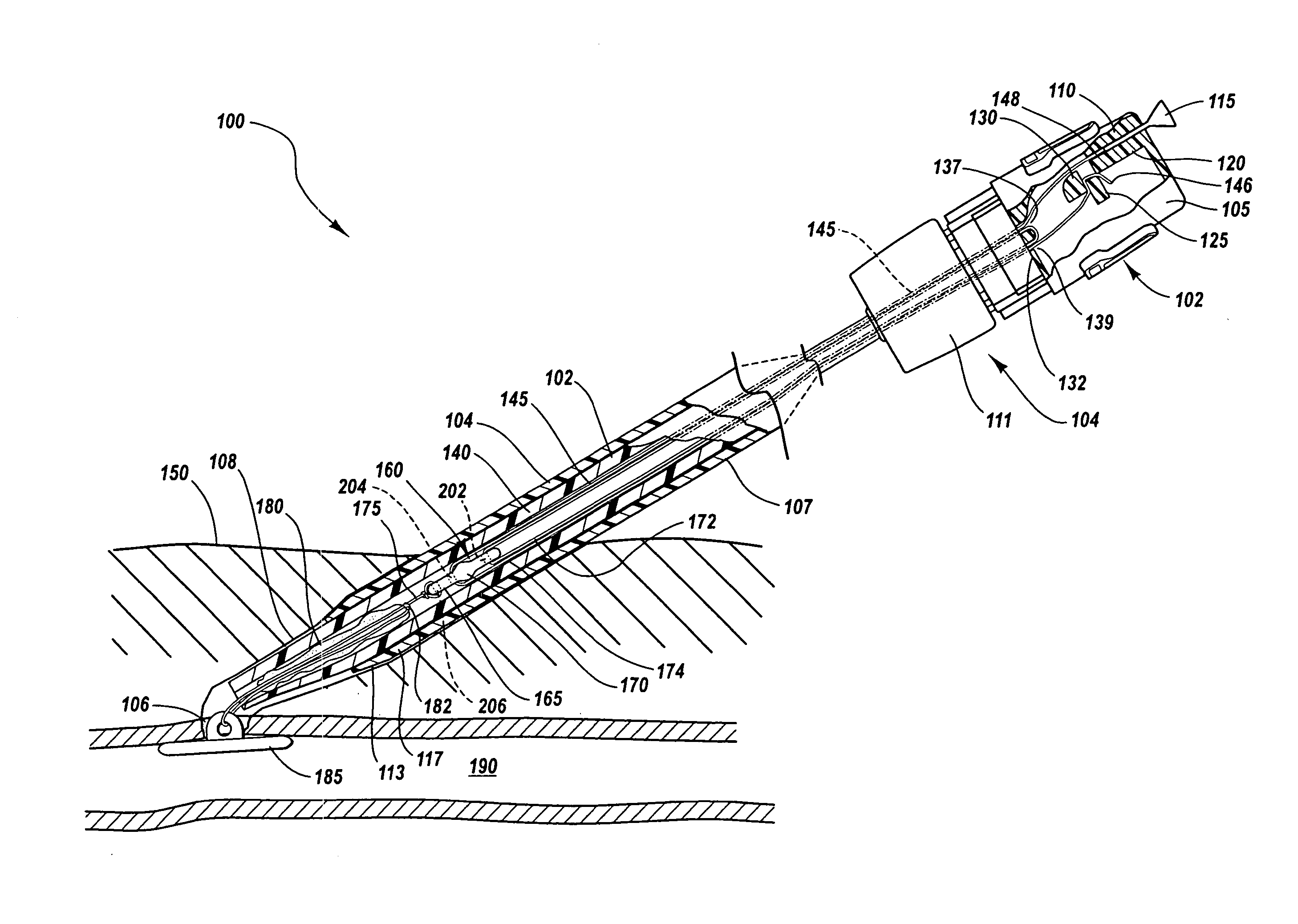 Method and apparatus for sealing an internal tissue puncture incorporating a block and tackle