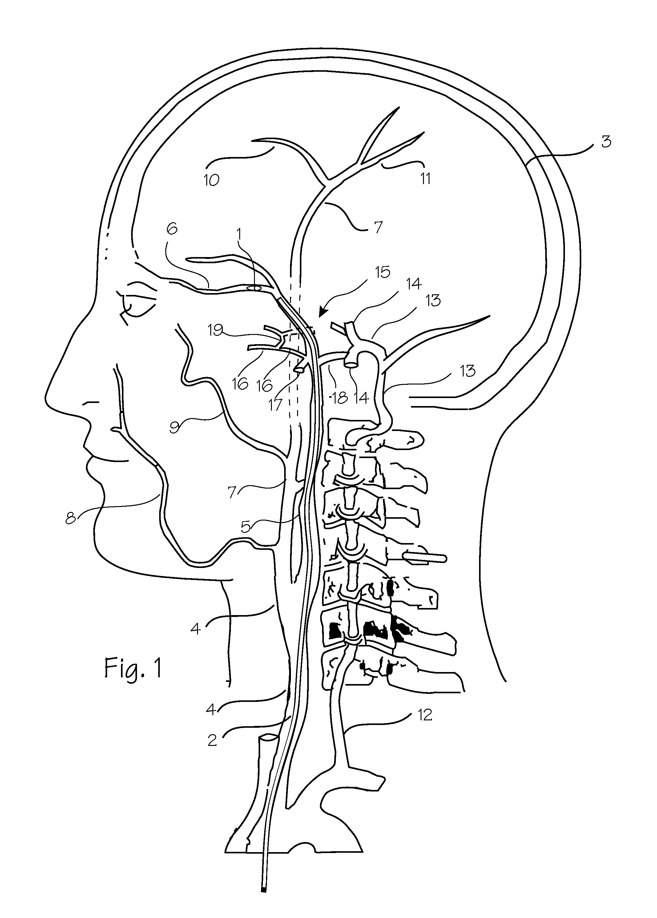 Embolic Implant and Method of Use