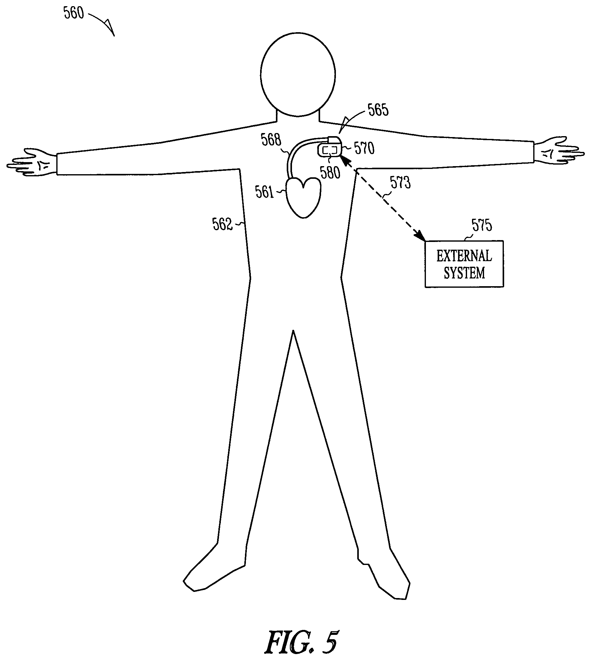 Devices, vectors and methods for inducible ischemia cardioprotection