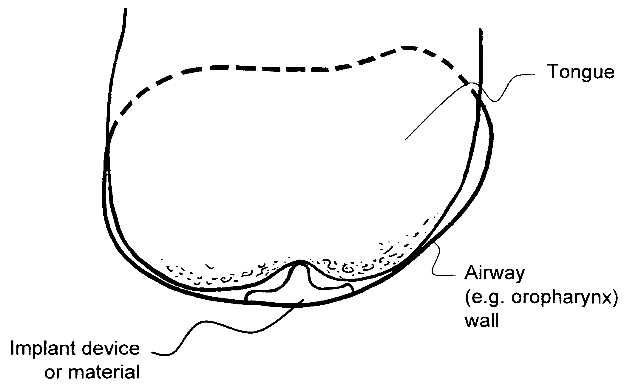 Method and apparatus for treating airway obstruction