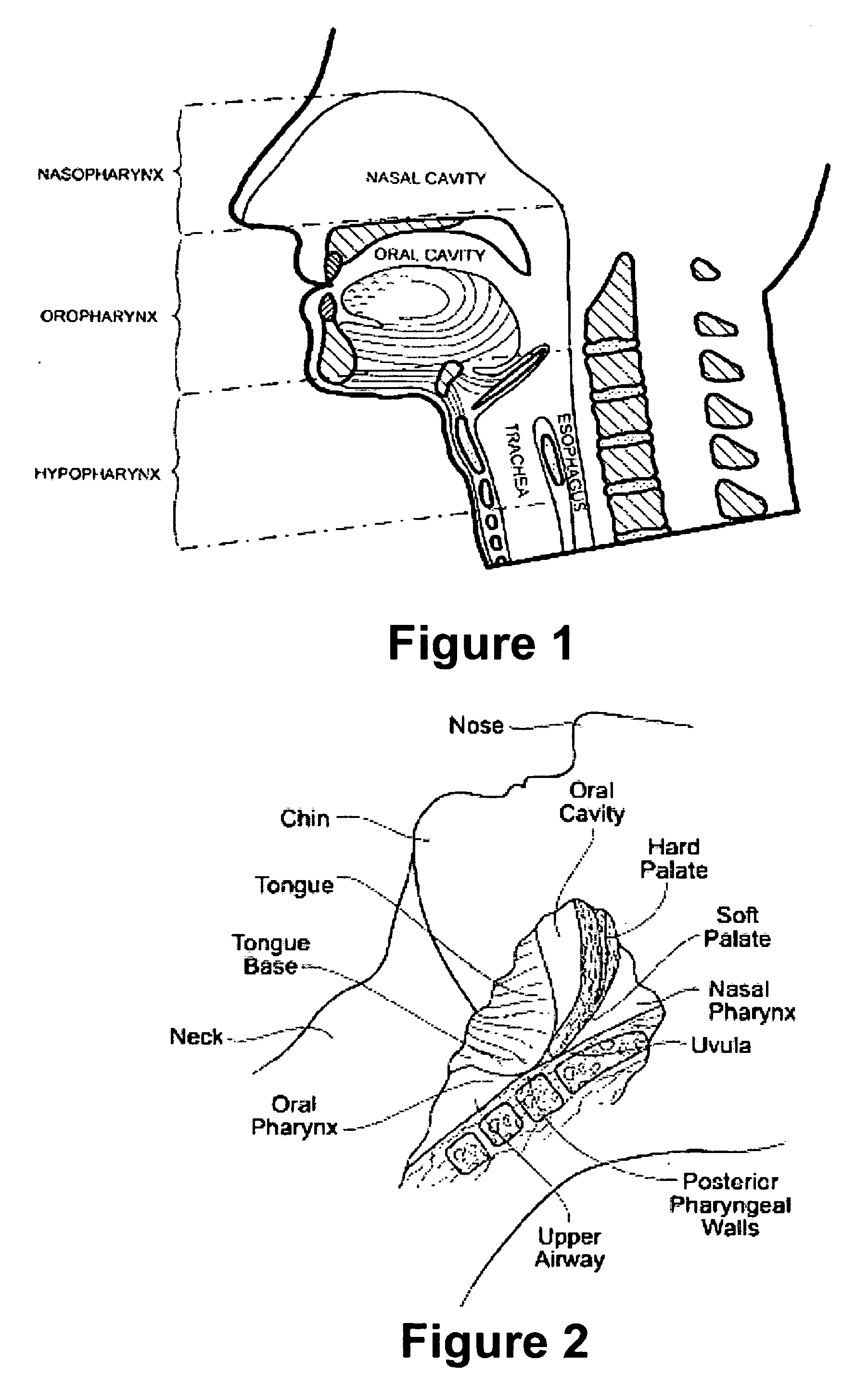 Method and apparatus for treating airway obstruction