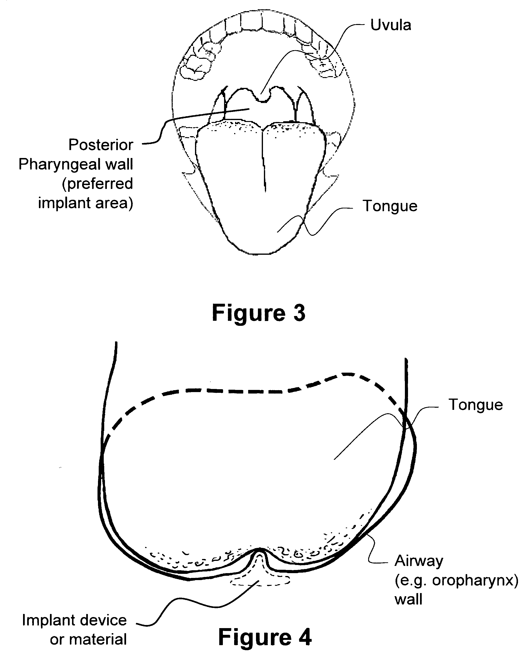 Method and apparatus for treating airway obstruction