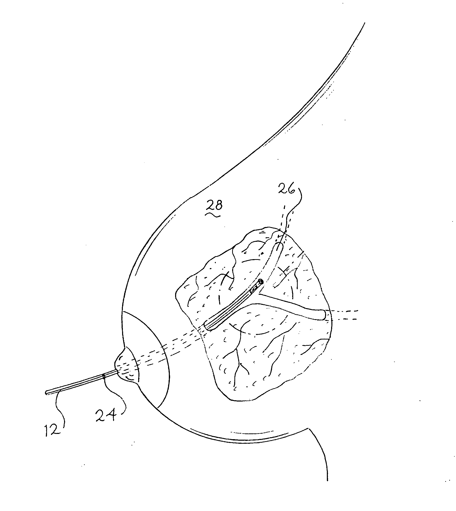 Marker and cut down guide assembly for human mammary duct procedures and method