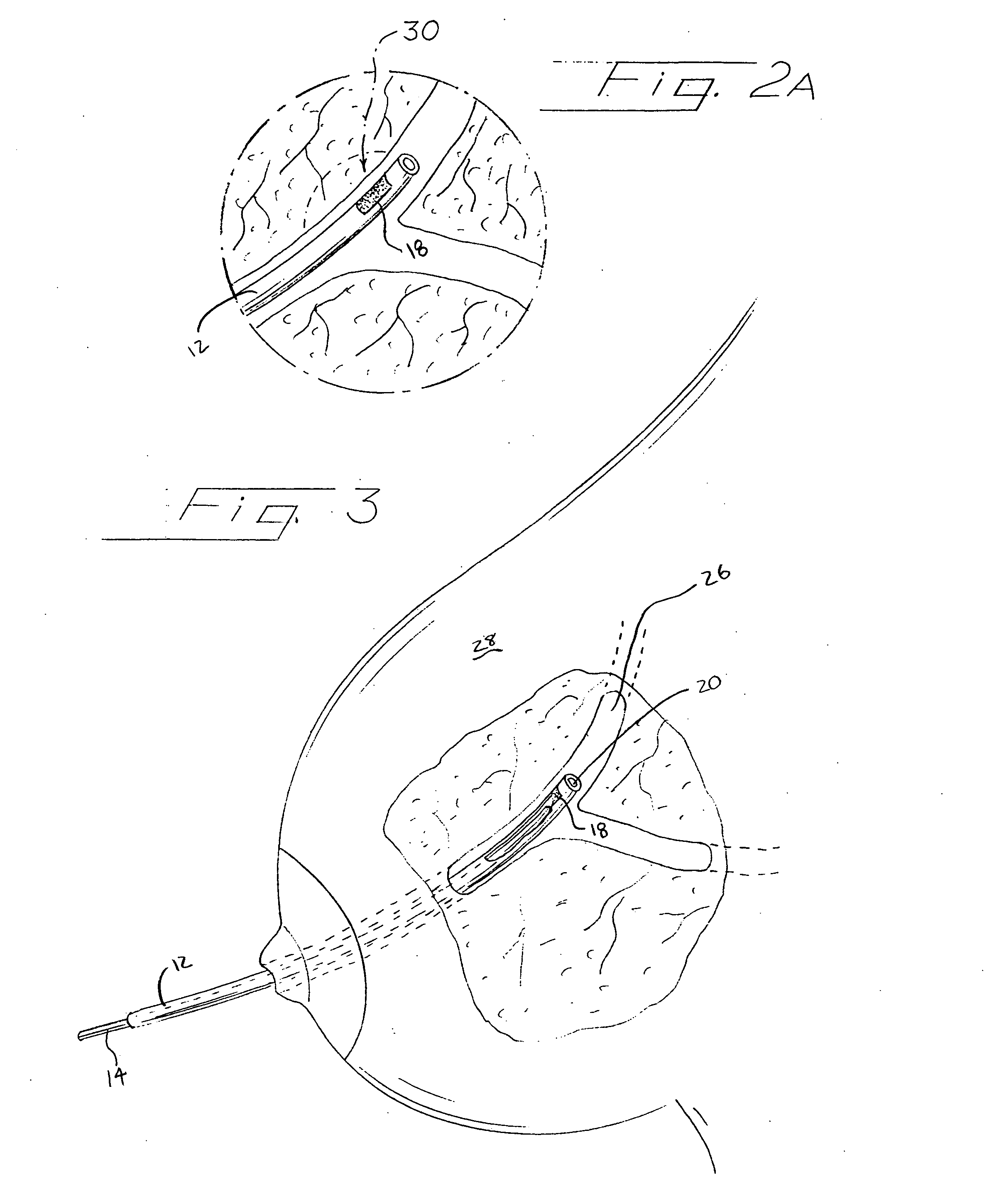 Marker and cut down guide assembly for human mammary duct procedures and method