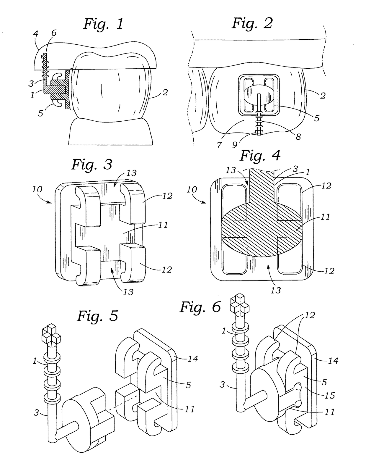 Programmable orthodontic indexing guide and bracket pin assembly and method of use