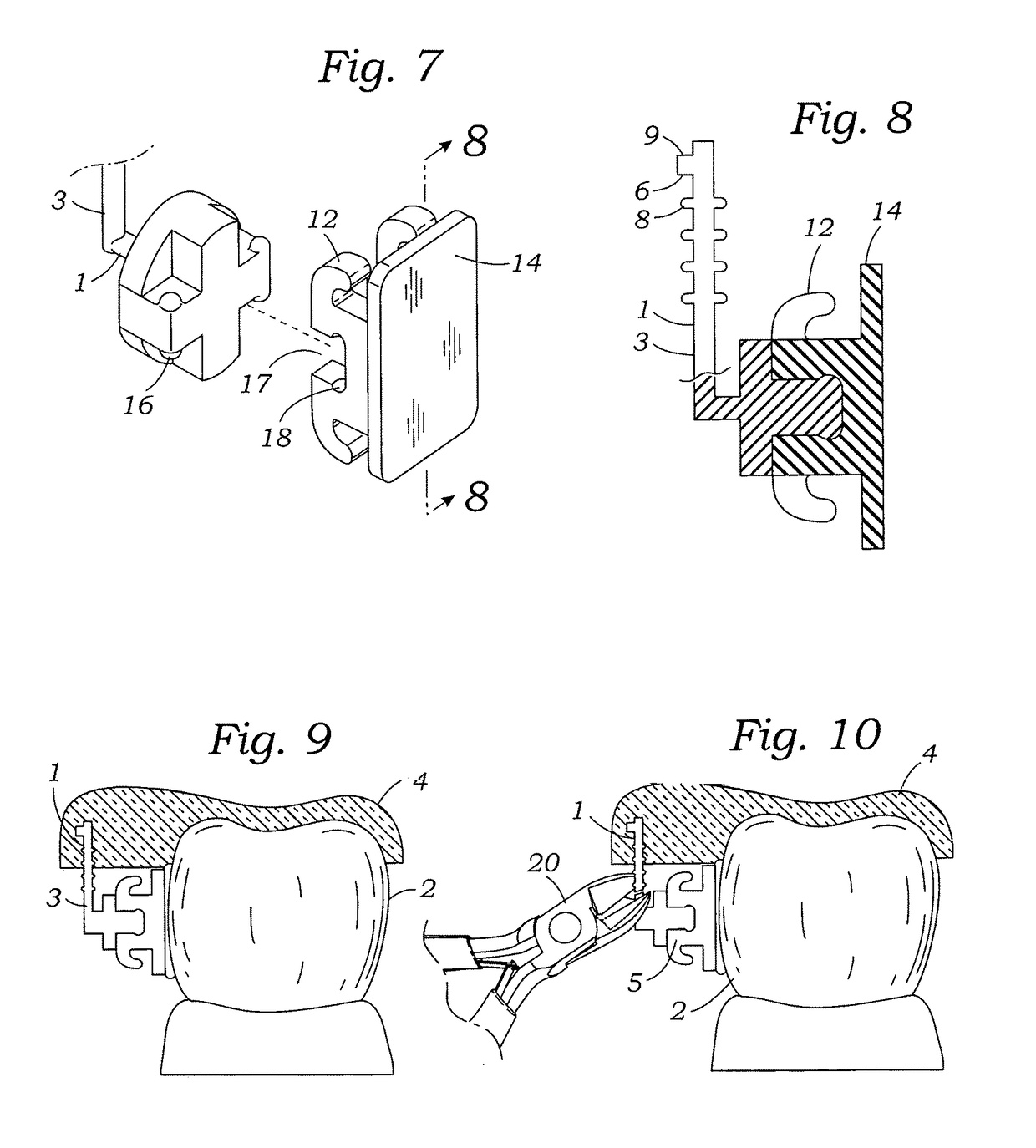 Programmable orthodontic indexing guide and bracket pin assembly and method of use