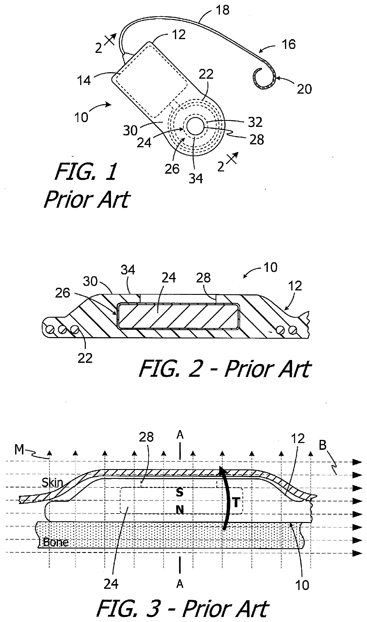 Cochlear implants, magnets for use with same and magnet retrofit methods