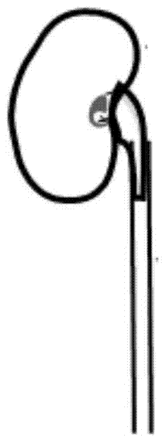 Establishment method for pig unilateral ureter obstruction recanalization model