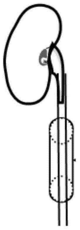 Establishment method for pig unilateral ureter obstruction recanalization model